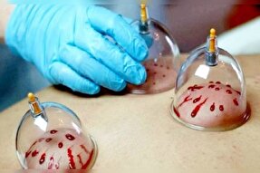 همه چیز درباره «حجامت» در فصل بهار